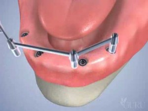 Technique d'implant molaire